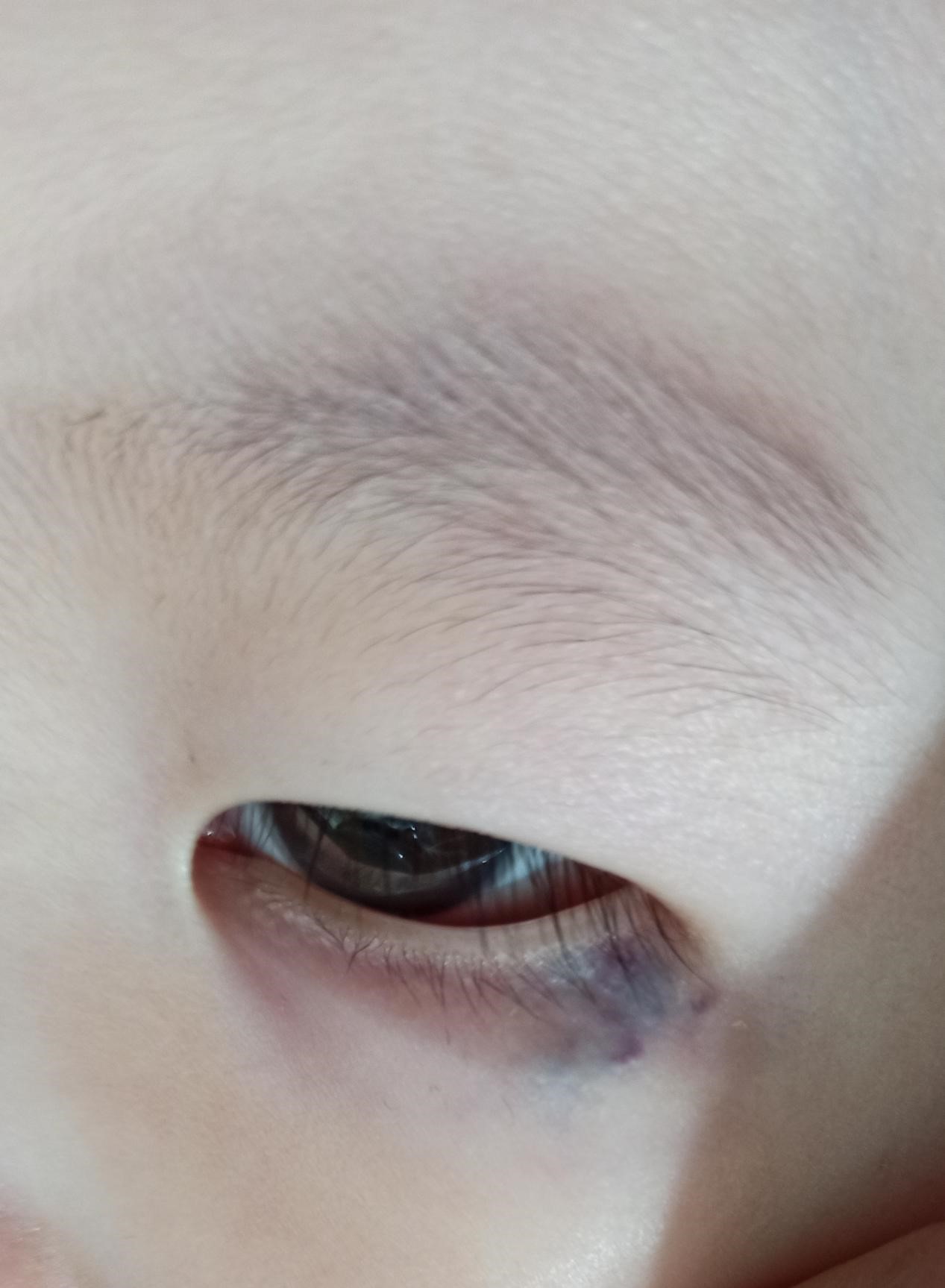 医生您好,我家孩子现在15个月了,左下眼睑有青紫色,疫情原因一直没去