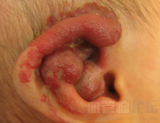 耳朵上长血管瘤会带来哪些危害