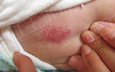 婴儿常见的血管瘤图片图片