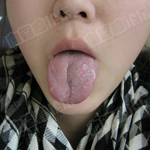 舌头毛细血管瘤的图片图片