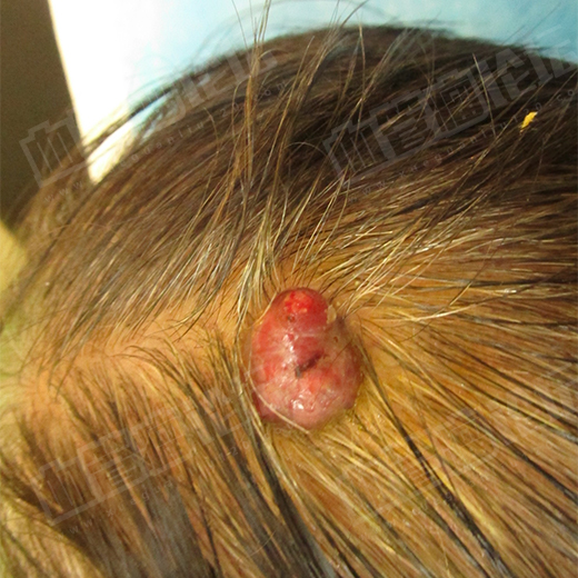 头皮血管肉瘤图片图片