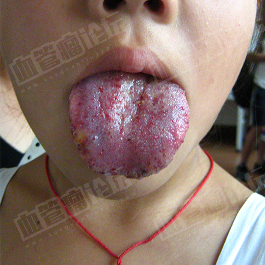 舌头有血管瘤图片图片