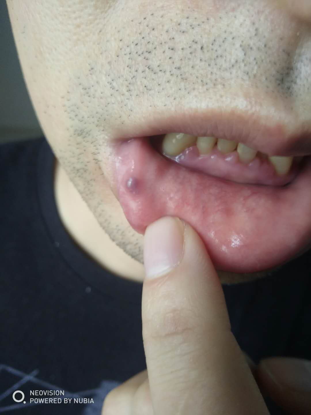 嘴唇上的有六七年了,压上去有硬块 嘴巴下方的小黑点