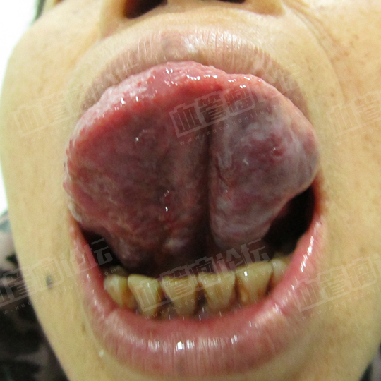 来自周碧舌头口腔成人血管畸形海绵状血管瘤患者日记