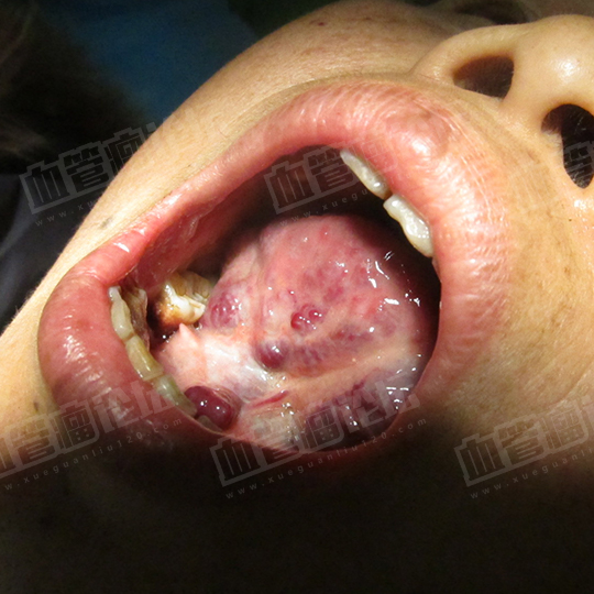 口腔血管瘤图片初期图片