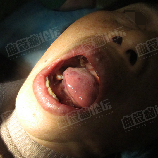 舌头海绵状血管瘤图片
