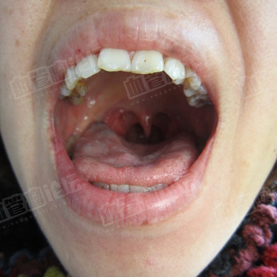 口腔里有个血管瘤图片
