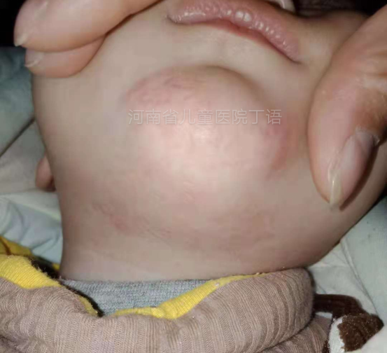 婴儿胆道闭锁图片
