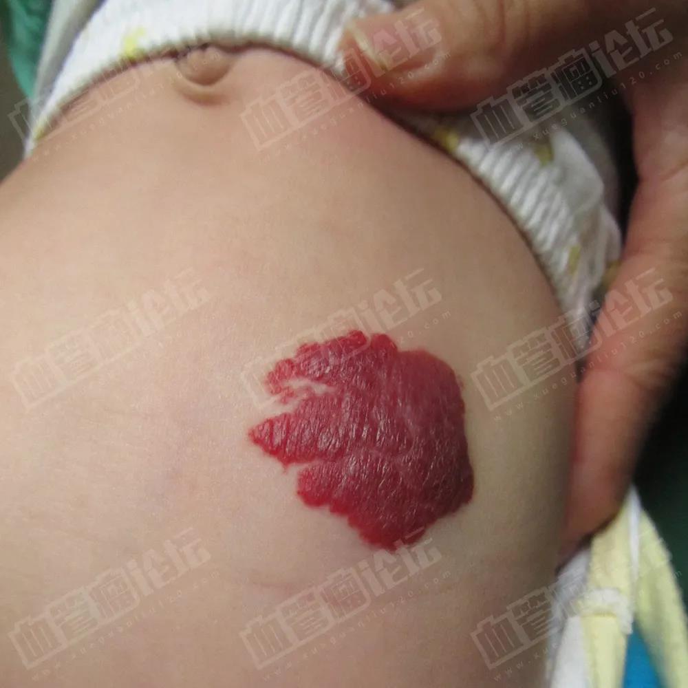 婴幼儿皮下血管瘤图片图片