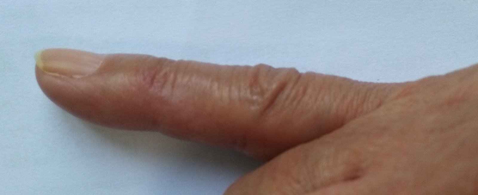 手指血管瘤的治疗 (治疗前后图片比较)