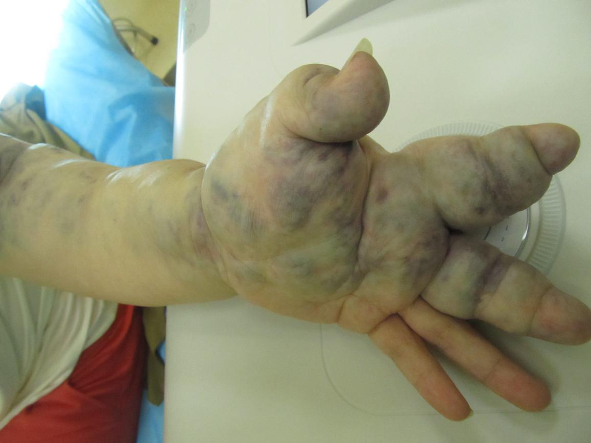 血管瘤22年了，从刚开始的大拇指和胳膊中间一点，现在蔓..._血管瘤论坛-中国血管瘤患者之家