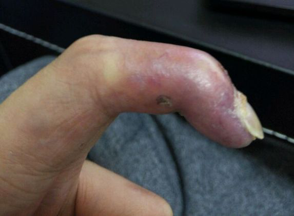 左手食指长了个血管瘤 去年一月份做过治疗 但是现在的..._血管瘤论坛-中国血管瘤患者之家