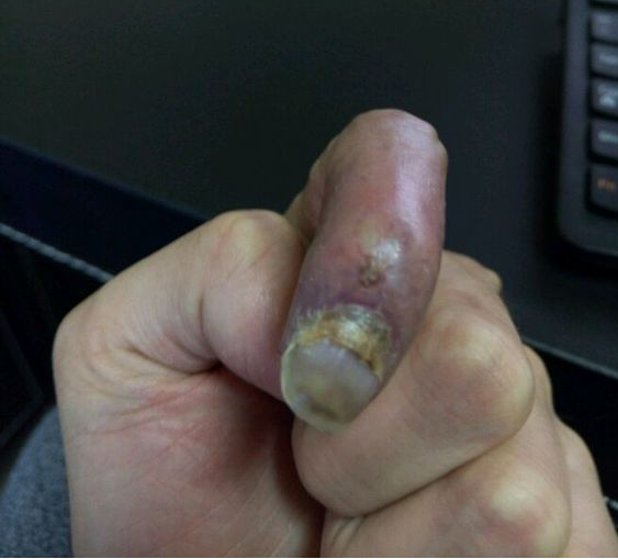左手食指长了个血管瘤去年一月份做过治疗但是现在的