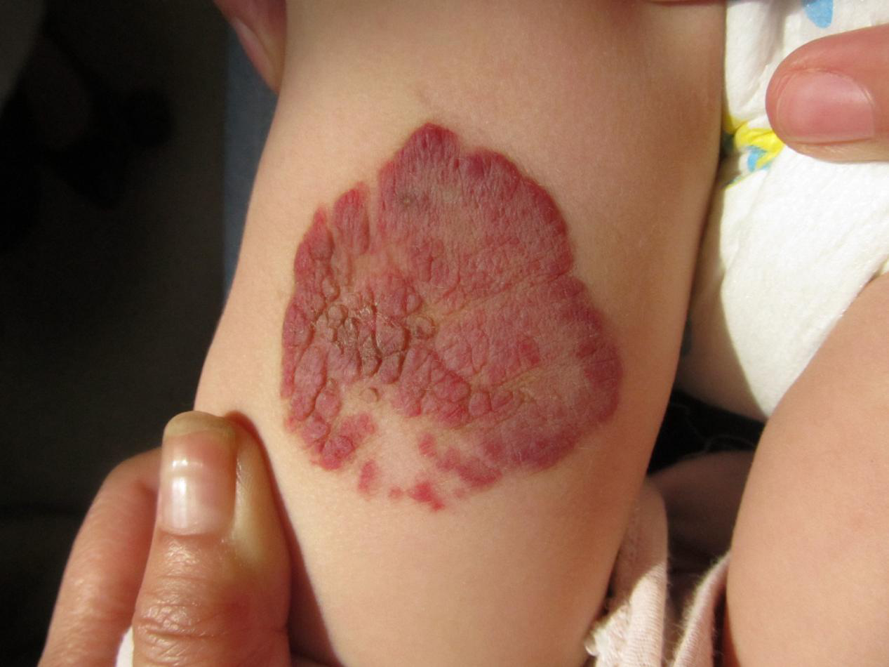 小孩子刚刚3个月，血管瘤已经长成这样，跪求不留疤的..._血管瘤论坛-中国血管瘤患者之家