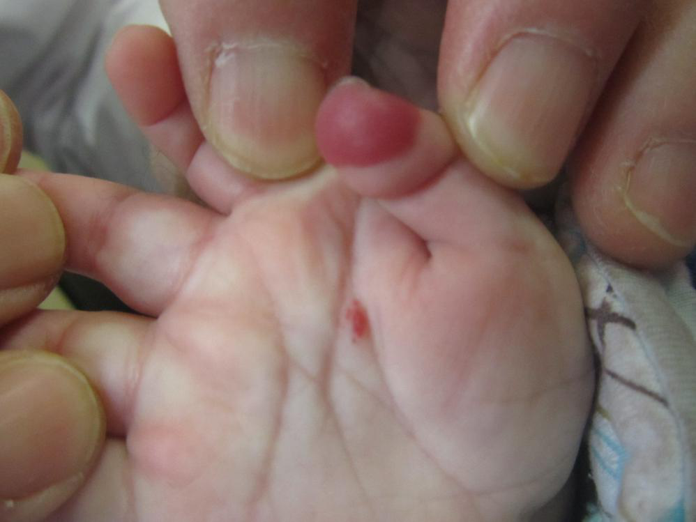 有没有哪家宝宝的血管瘤长手指尖上的.宝宝50天了，没有..._血管瘤论坛-中国血管瘤患者之家