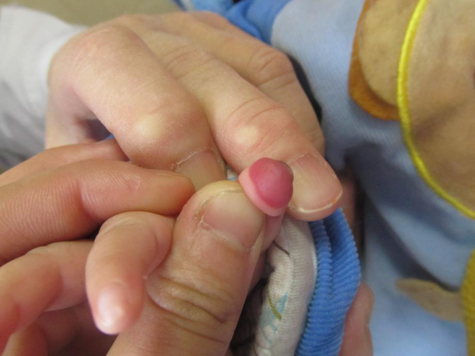 有没有哪家宝宝的血管瘤长手指尖上的宝宝50天了没有