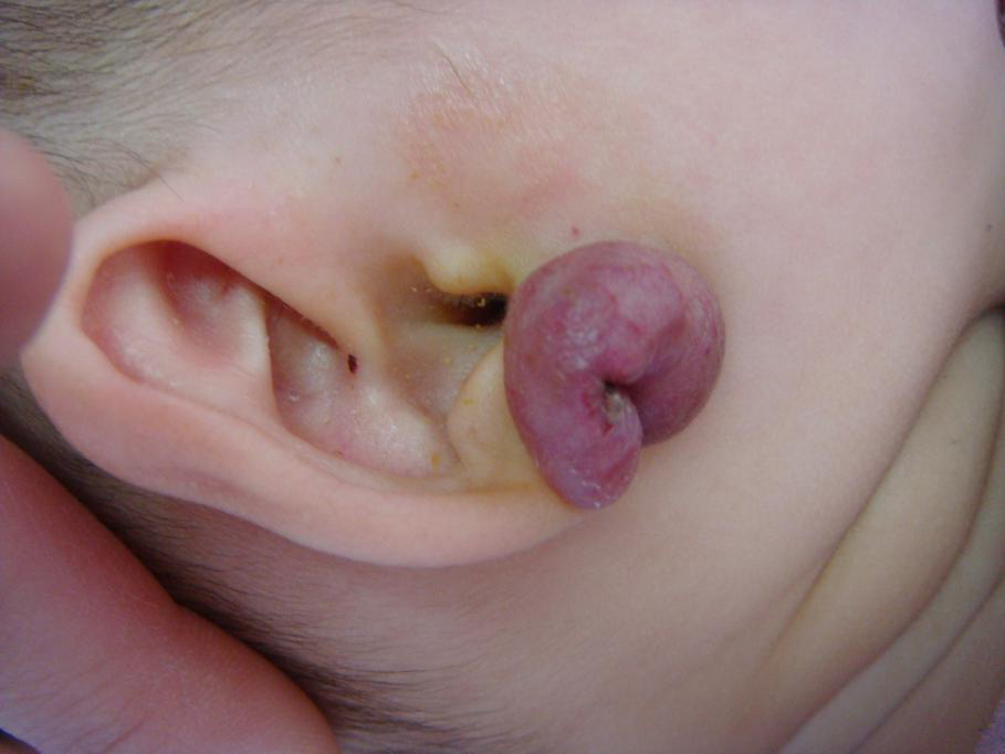 宝宝耳朵上的是血管瘤吗，请问怎么求治疗_血管瘤论坛-中国血管瘤患者之家
