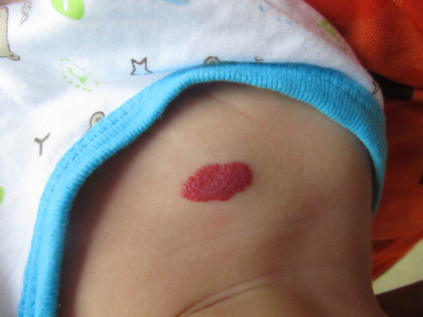 宝宝身上血管瘤的图片图片
