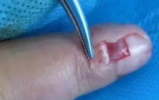 左手食指长了个血管瘤 去年一月份做过治疗 但是现在的..._血管瘤论坛-中国血管瘤患者之家