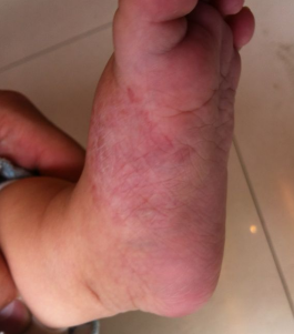 小宝一个多月，整个脚掌红肿，不敢给它洗脚，怕发生异常_血管瘤论坛-中国血管瘤患者之家