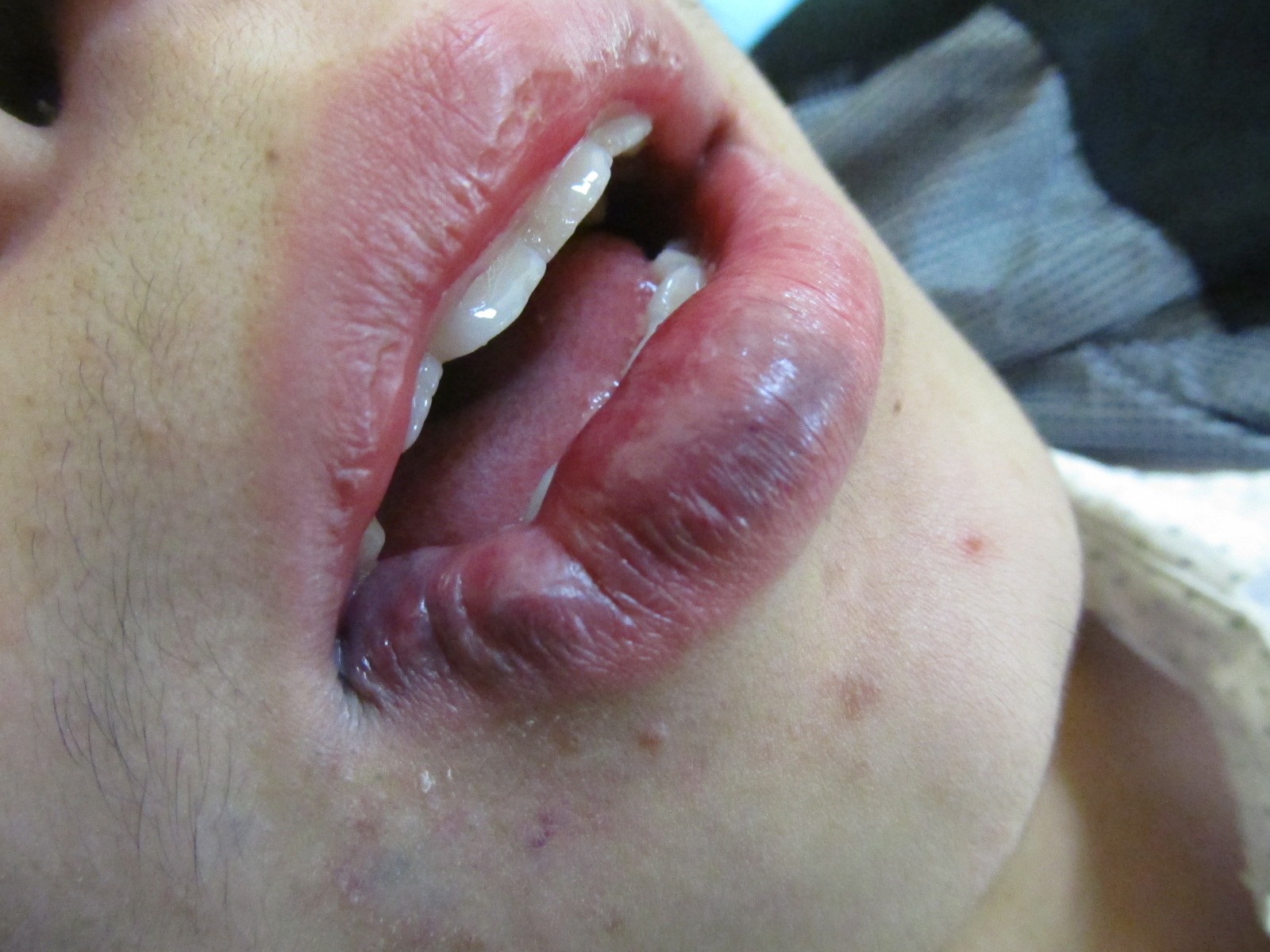 成人嘴唇血管瘤图片