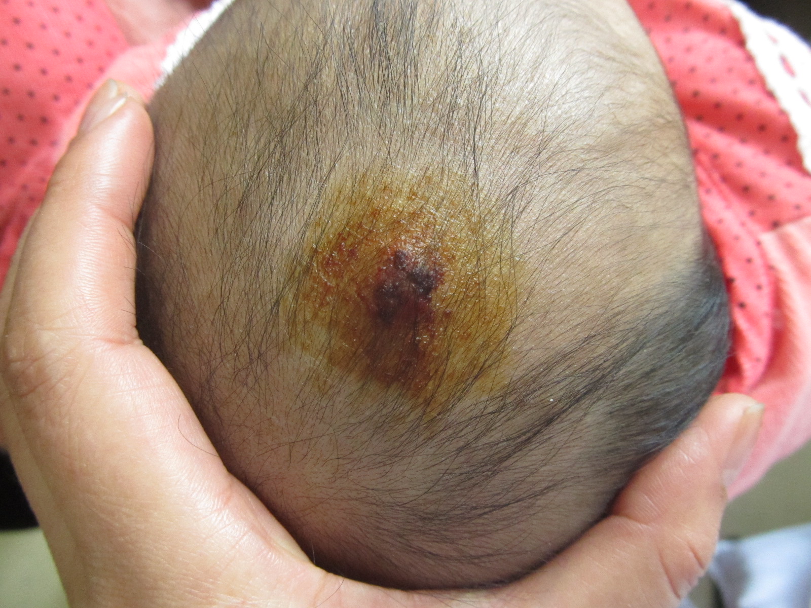宝宝后脑勺血管瘤图片图片