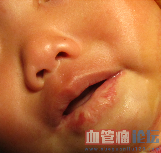 宝宝口服心得安治疗血管瘤半年反馈_血管瘤论坛-中国血管瘤患者之家