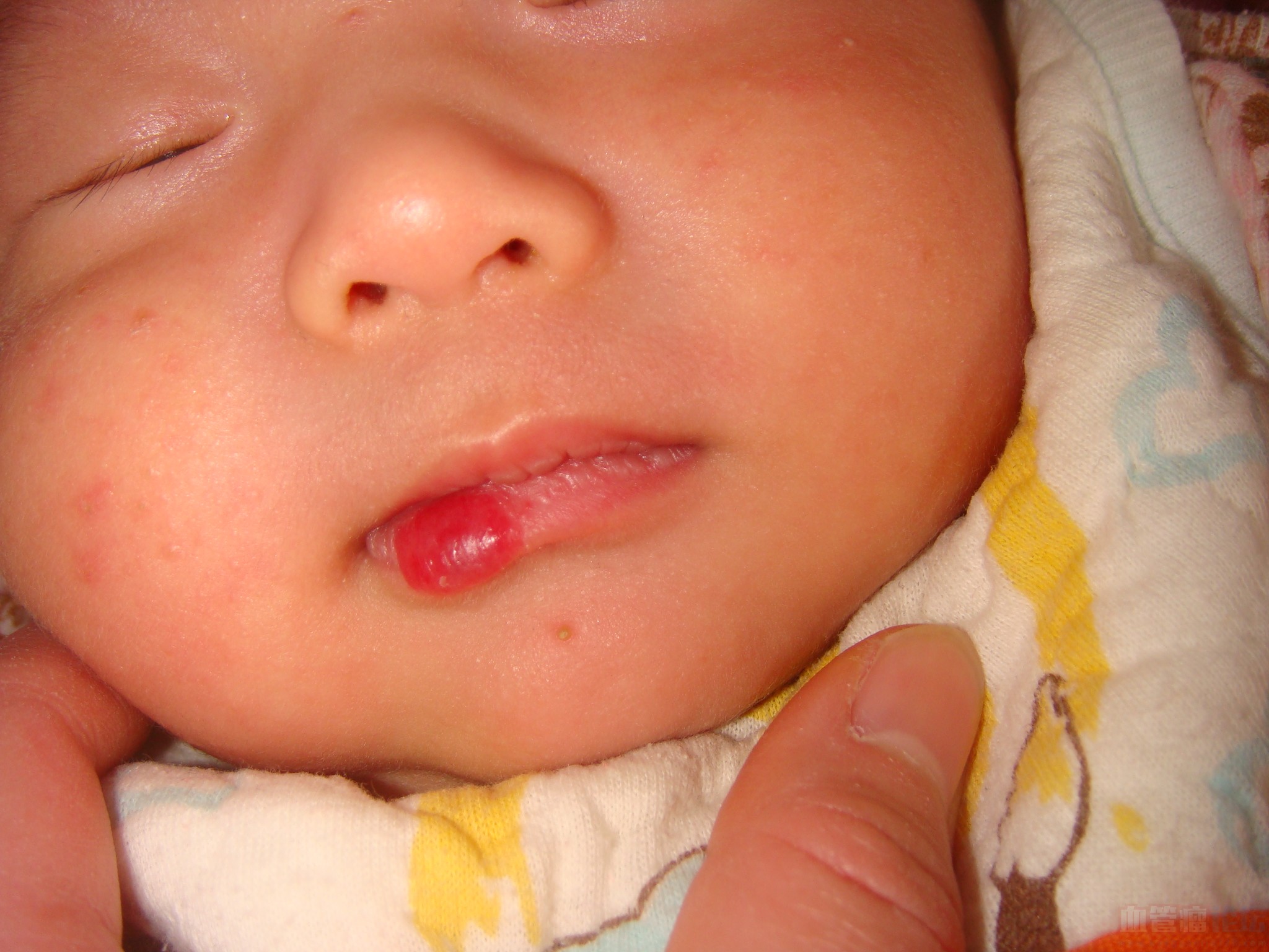 我家宝宝嘴唇上的血管瘤可以用阻断治疗吗_血管瘤论坛-中国血管瘤患者之家