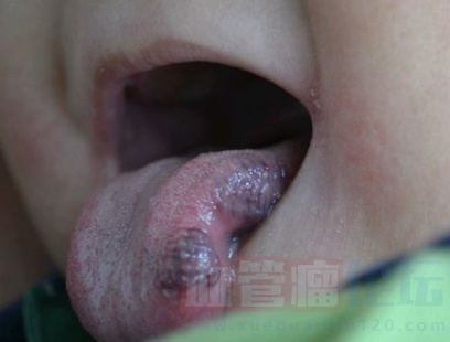 血管瘤像桑梓一样长在舌头里，宝宝经常用手去扣，怎么..._血管瘤论坛-中国血管瘤患者之家