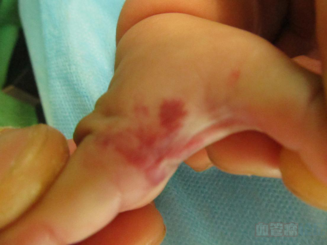 我女儿手上的什么类型的血管瘤