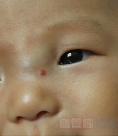 我宝宝现在4个多月，刚出生时鼻边边有个小红点，以为是..._血管瘤论坛-中国血管瘤患者之家