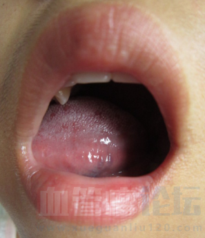 口腔血管瘤 各位求治疗方案 在舌苔下方，无疼痛感，2岁_血管瘤论坛-中国血管瘤患者之家