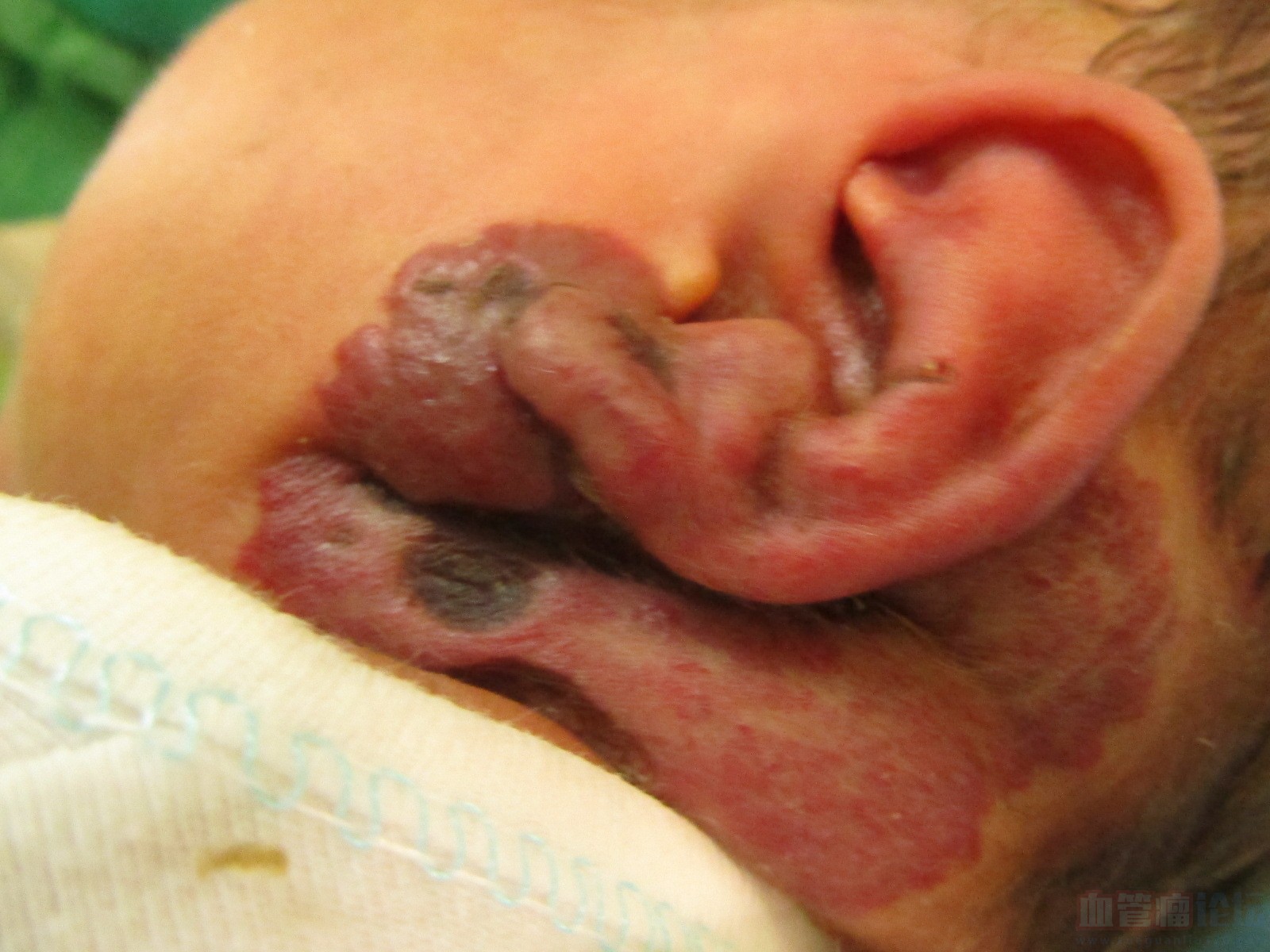 2个月宝宝长了大面积血管瘤，最近还溃烂了，该怎么办_血管瘤论坛-中国血管瘤患者之家