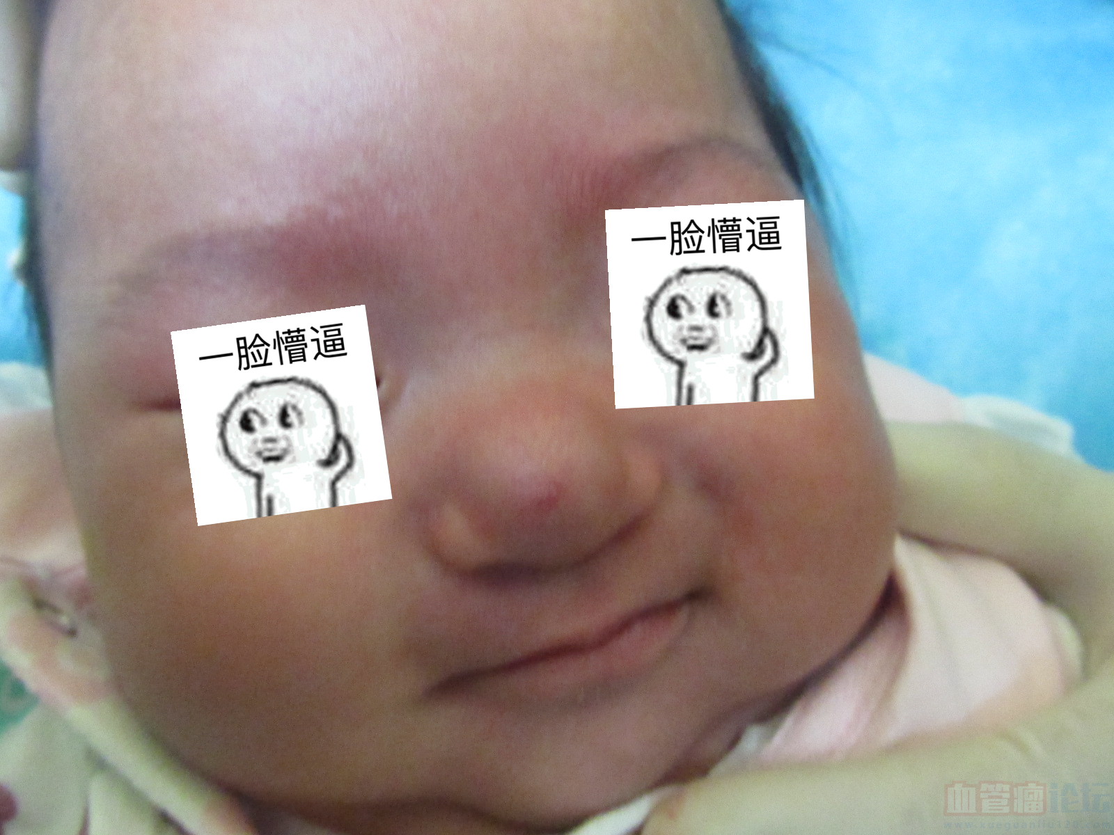 药物能治疗宝宝鼻部的血管瘤吗_血管瘤论坛-中国血管瘤患者之家