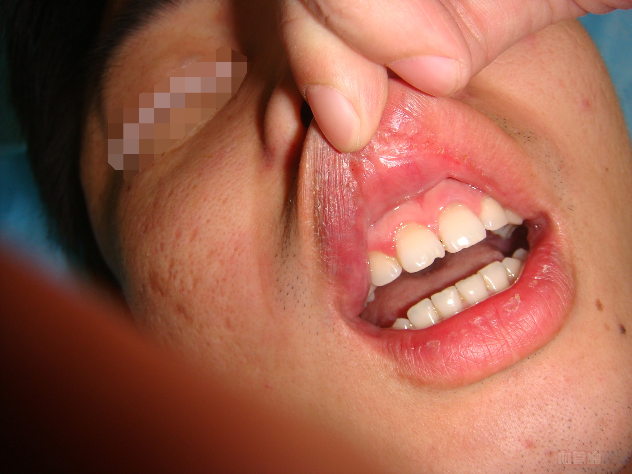 有没有牙龈处长血管瘤的吗