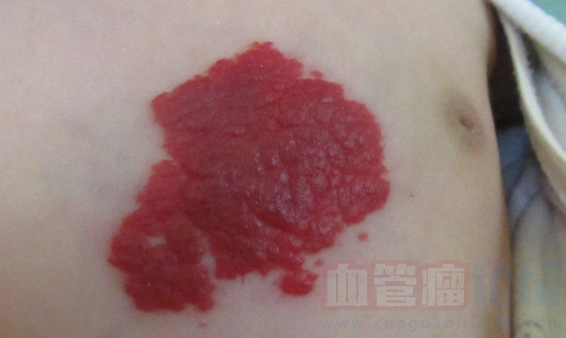 宝宝胸口的血管瘤该怎么办_血管瘤论坛-中国血管瘤患者之家