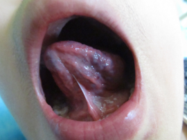 孩子舌头上的小颗粒是血管瘤还是上火？？_血管瘤论坛-中国血管瘤患者之家