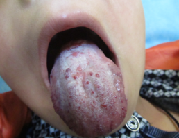 孩子舌头上的小颗粒是血管瘤还是上火？？_血管瘤论坛-中国血管瘤患者之家