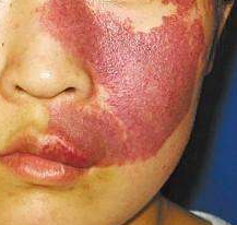对照看看你的鲜红斑痣是哪种类型和存在哪些危害_血管瘤论坛-中国血管瘤患者之家