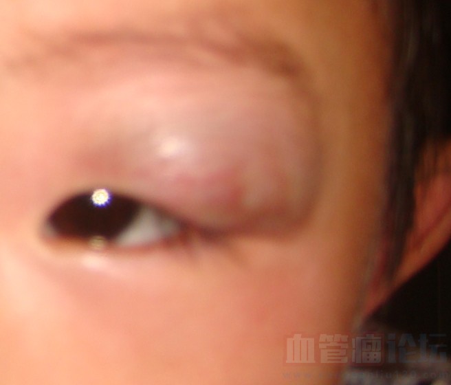 眼睛上的血管瘤怎么办啊_血管瘤论坛-中国血管瘤患者之家