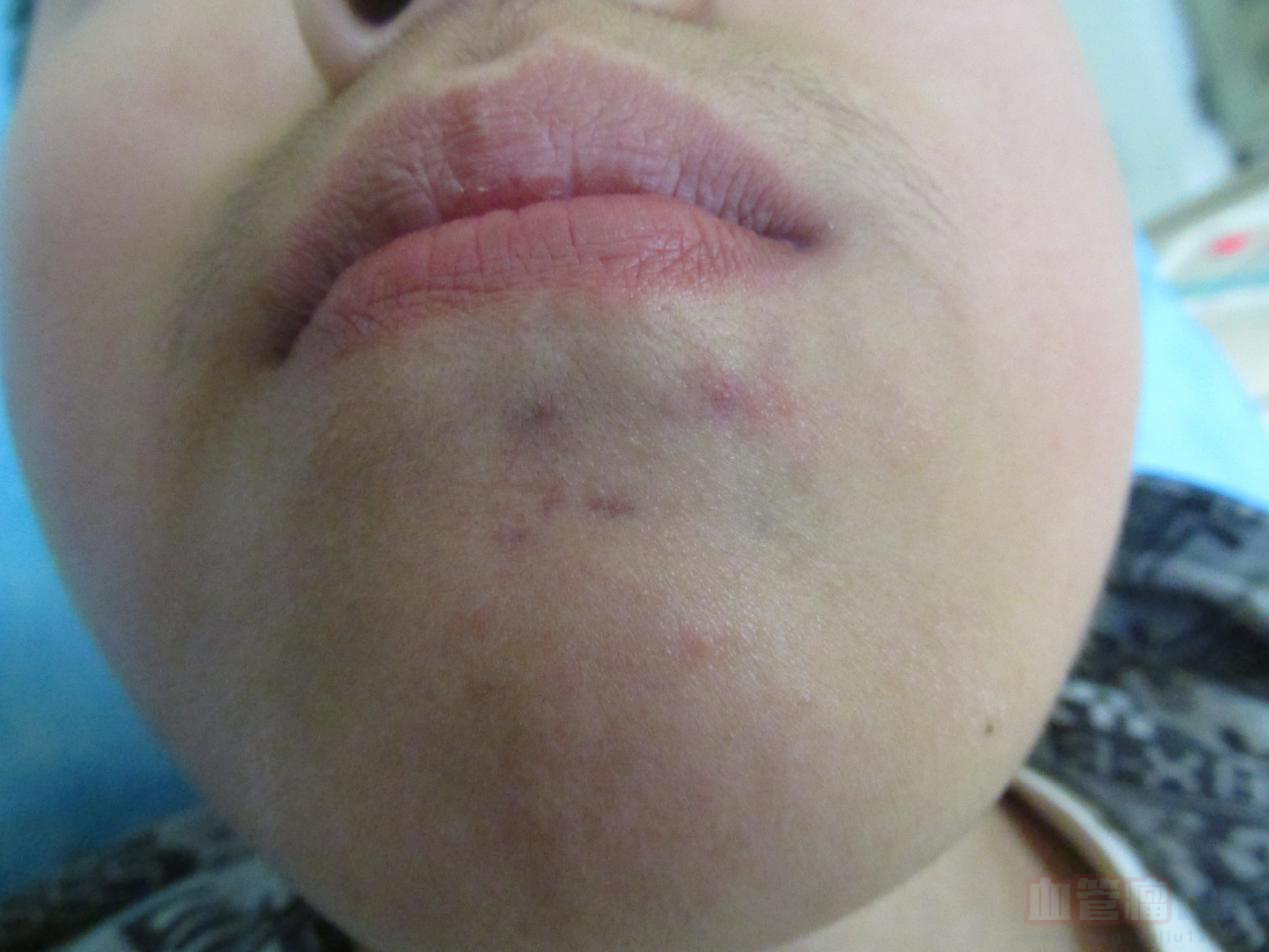 舌头上诊断为血管瘤,女,36岁,口腔科医生建议手术切除