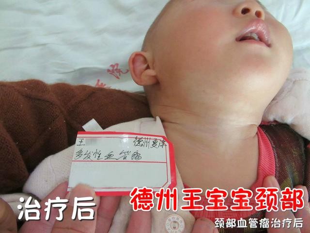 宝宝脖子长了血管瘤怎么办？3点注意3秒读懂血管瘤_血管瘤论坛-中国血管瘤患者之家