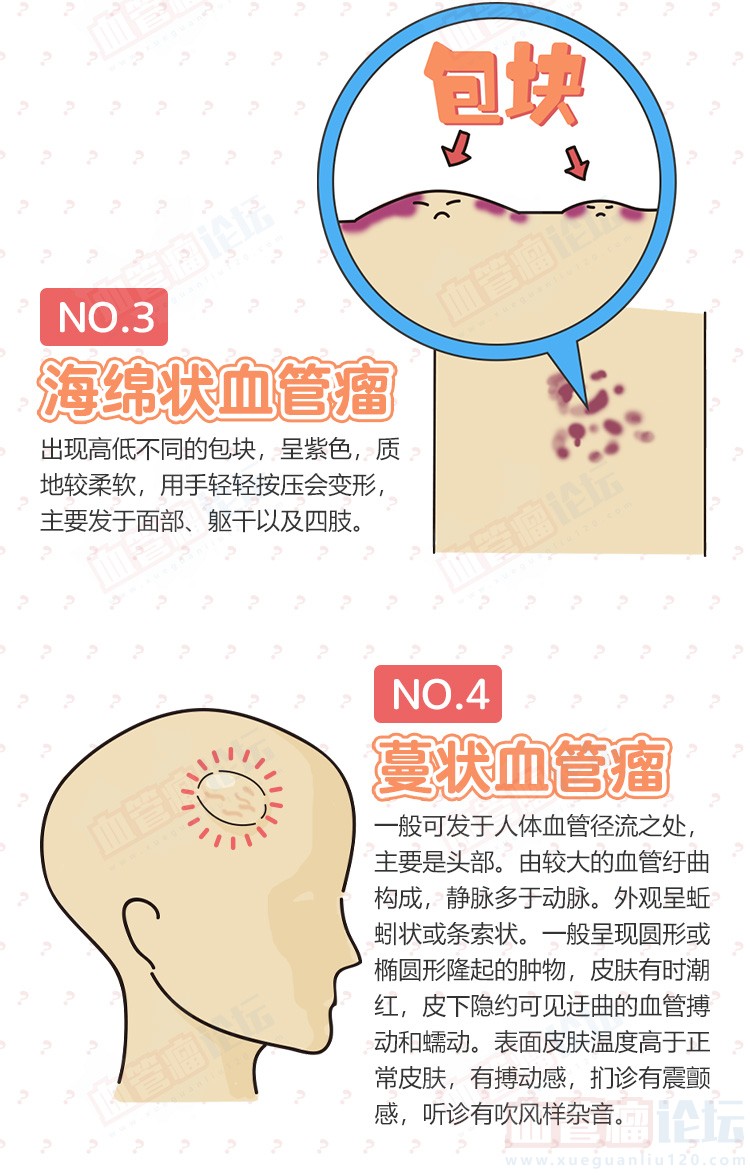 常见的血管瘤有哪些？_血管瘤论坛-中国血管瘤患者之家