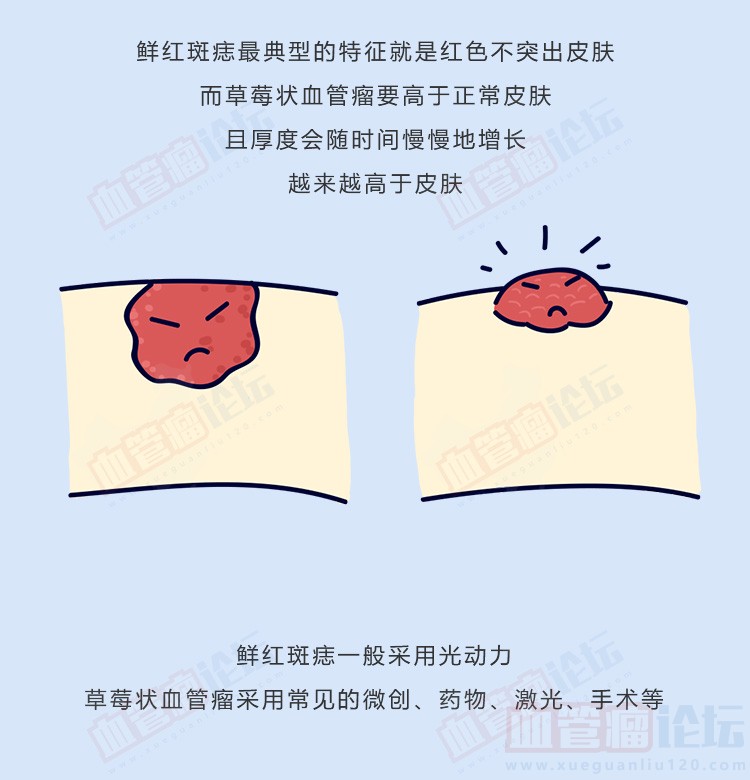 草莓状血管瘤和鲜红斑痣的区别_血管瘤论坛-中国血管瘤患者之家