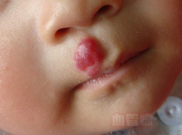 嘴巴上长血管瘤严不严重，请教治疗方法_血管瘤论坛-中国血管瘤患者之家