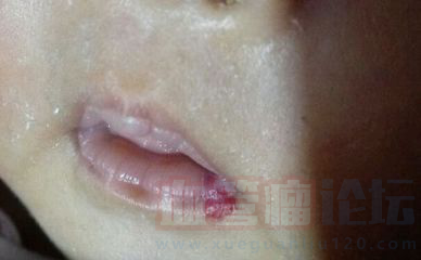 婴儿唇部血管瘤，嘴角有一块微凸起，是草莓状的，嘴唇..._血管瘤论坛-中国血管瘤患者之家
