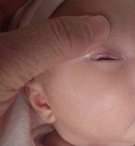 眼睑下方有一个小红点，请问哪种治疗方式宝宝能接受_血管瘤论坛-中国血管瘤患者之家