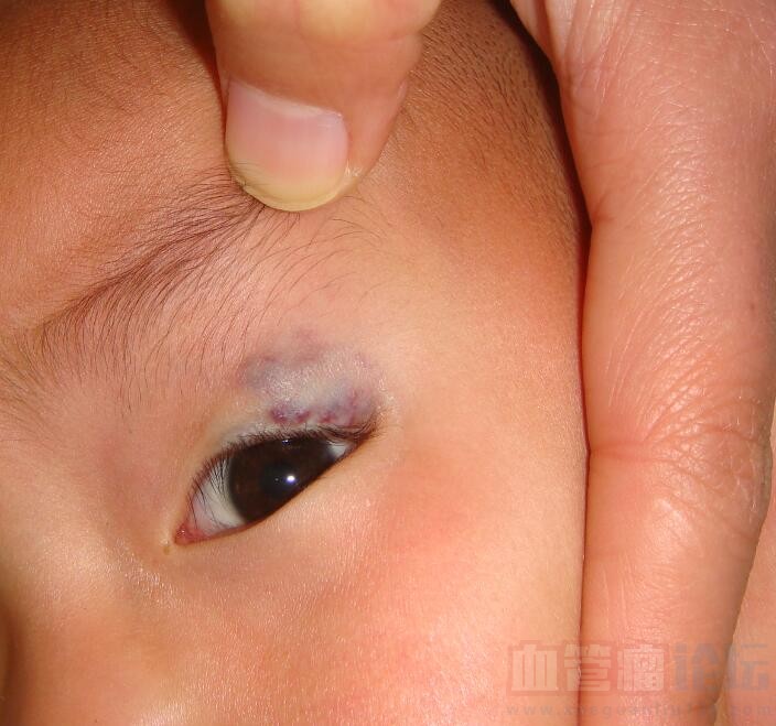 大家看看，我家孩子眼皮上这个是血管瘤吗？_血管瘤论坛-中国血管瘤患者之家