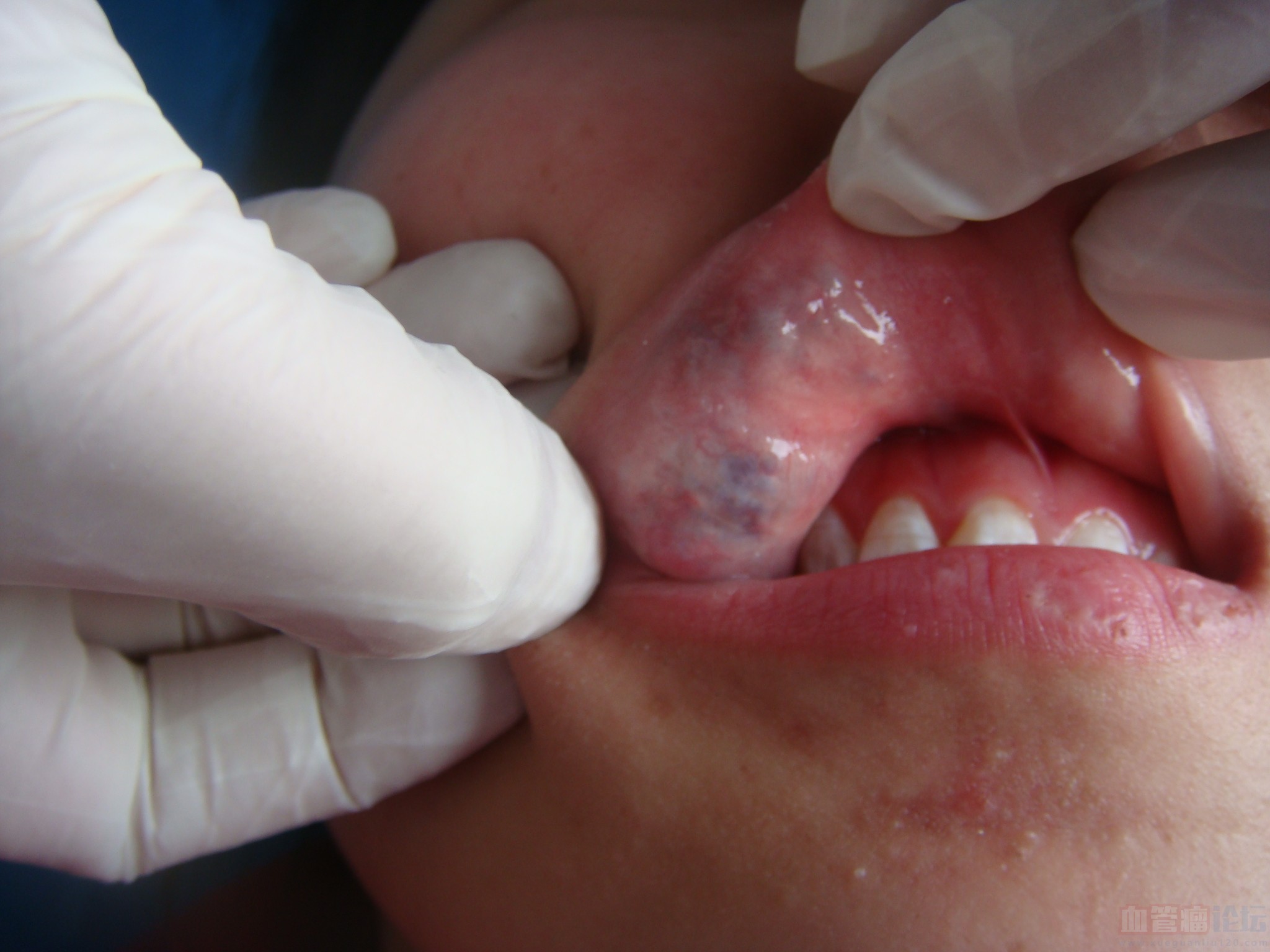 嘴唇长血管瘤初期图片图片