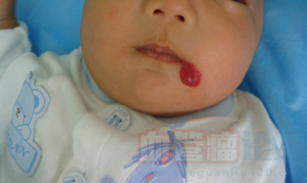 嘴角凸起血管瘤，2个多月，出生时没有这么红也没有这么大_血管瘤论坛-中国血管瘤患者之家